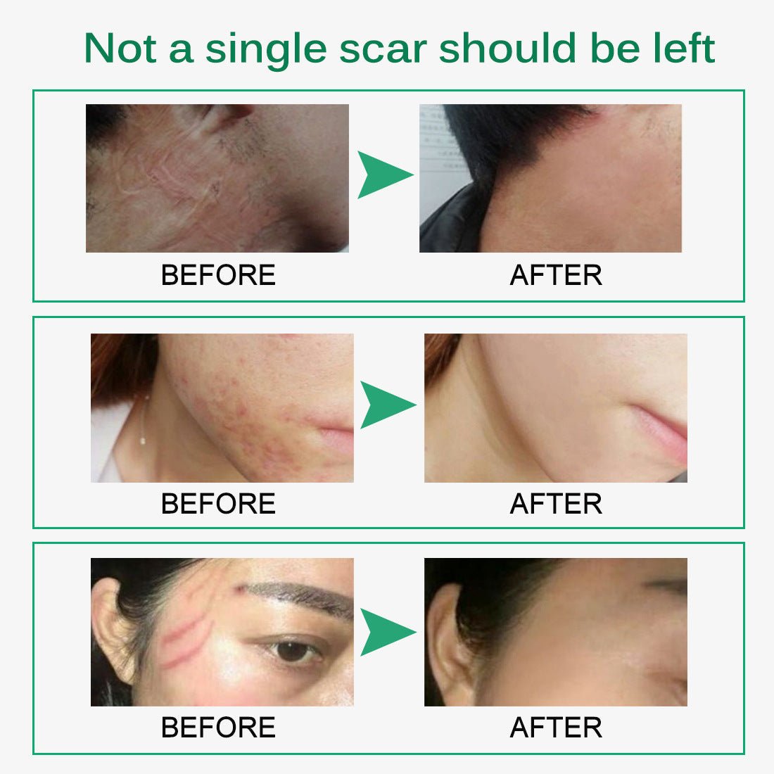 Skin Rebound Scarless Cream Scar Removal Cream Face Cream For Face Acne Scar Stretch Marks Skin Repair Face Cream | Luxury Home Accessories | Heulog Glow